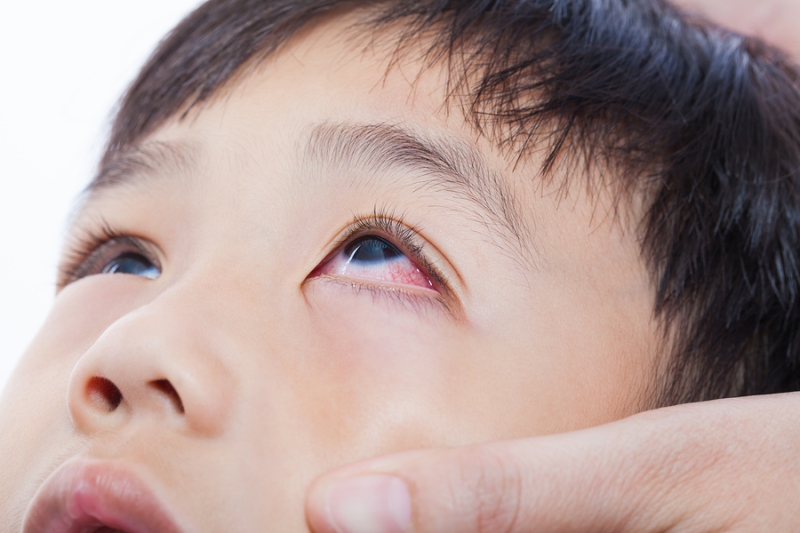What is Pink Eye? Here's a Closer Look at Conjunctivitis SUNY College