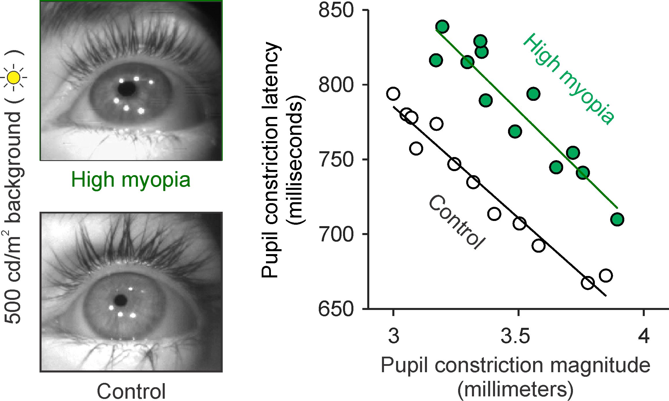 Myopia pupil