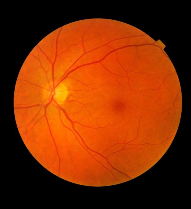 Photo of retina