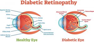 Diabetic_Retinopathy by AOA